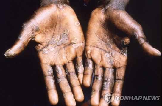 원숭이두창, 유럽·북미 등 전세계 확산세