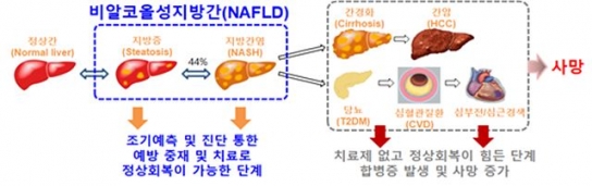 비알코올지방간질환 환자에서 간 섬유화 진행을 막으려면…