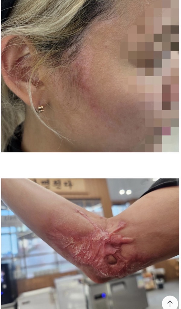 “두 달 된 전기튀김기 폭발…중화상 피해 호소”